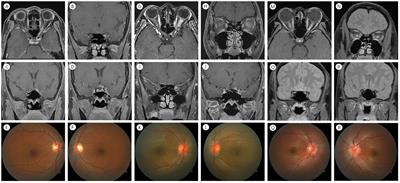 Clinical features of COVID-19-related optic neuritis: a retrospective study
